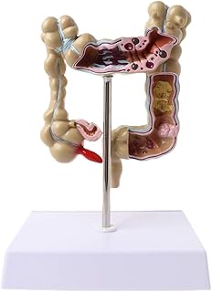 Anatomy Models, Colon Human Anatomical Model with Pathologies, Human Colorectal Lesion Model for Doctor-Patient Communication Medical Training Teaching Aid