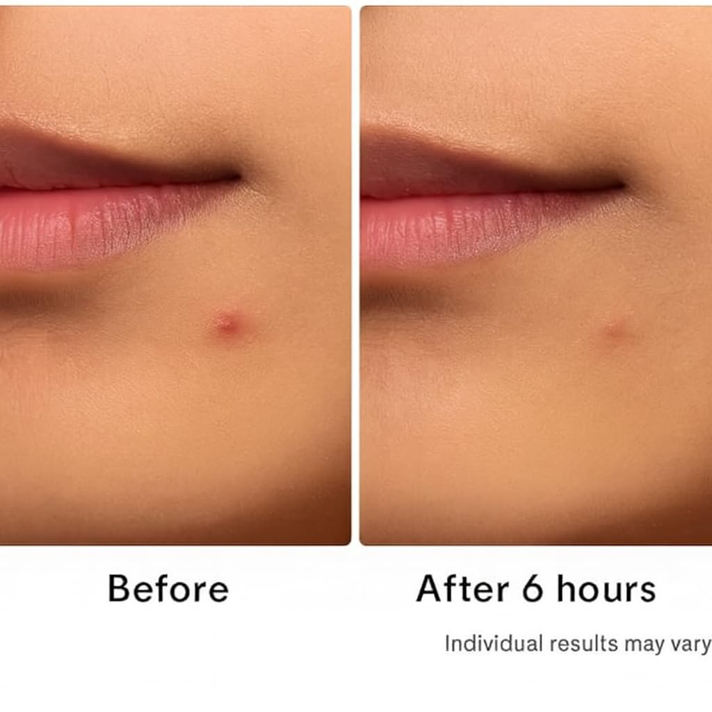 Hydrocolloid Acne Patches, 72 Count – Invisible & Waterproof Pimple Patches with Strong Adhesion, Gentle on Skin – for Whiteheads & Blemishes | GXZ Health - Image 4