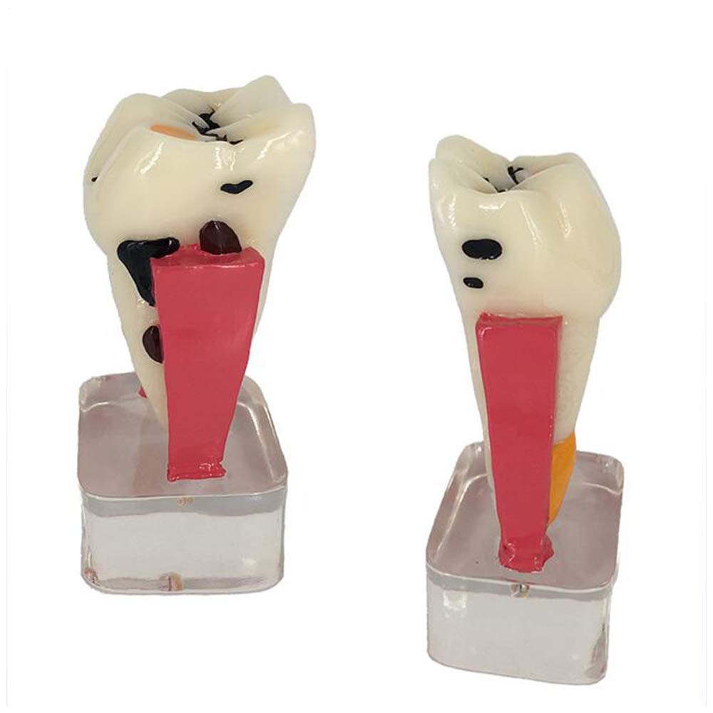 Modèle D'Implant Dentaire – Modèle Anatomique des Dents – Modèle D'Étude des Soins Dentaires – Modèle De Dent De Démonstration en Coupe Transversale