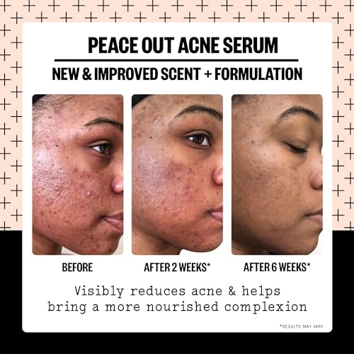 Peace Out Skincare Acne Serum. Daily Multi-Benefit Face Serum with 2% Salicylic Acid to Target Pimples, Zits, Blemishes and Breakouts, For Clearer-Looking Skin 1 fl oz - Thumbnail 3