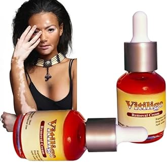 Vitiligo Cream For White Patches, Helps to Fade White Spots Safed Daag and Even Out Skin Tone, Non-Irritating For All Skin Types, and Ideal for Both Men and Women.
