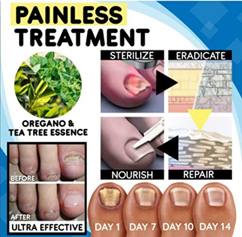 Antischimmelbehandelingsset voor thuis, teennagelbehandelingspen voor snel effect voor nagelschimmel, zoals onychomycose… - Image 7