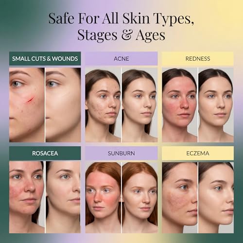 Jusspray™ Hypochlorous Acid Spray for Face and Skin | HOCI Facial Cleanser Mist | 8 oz Hypochlorous Acid for Face, Skin, Acne, Eczema, Body Acne Sprays, Piercing Aftercare, Wound Solution