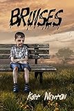 Bruises