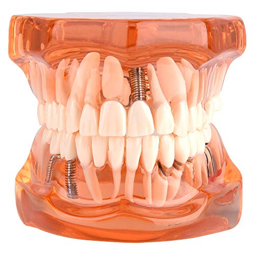 FTVOGUE Estudio de Demostración Desmontable de Modelo de Dientes de Enseñanza de Enfermedad Dental de Color Naranja para Dentistas y Escuelas