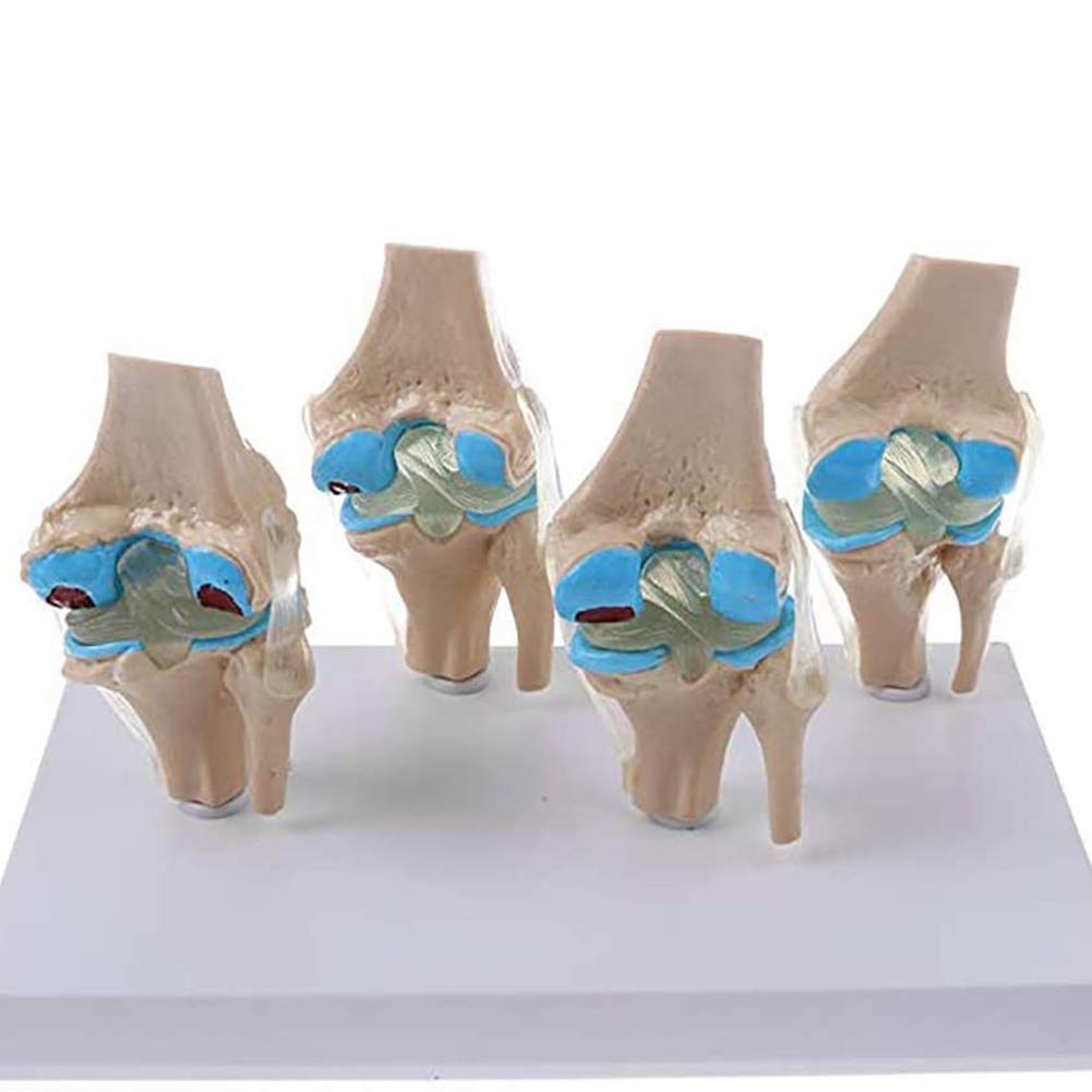Buy Knee Joint Model Set,Human Body Anatomy Replica Set Of 4Stage