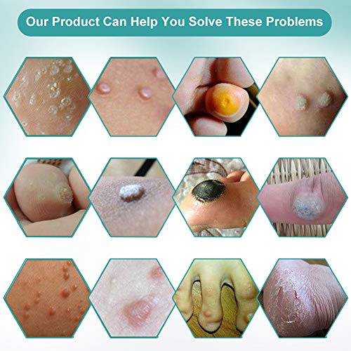 Wart Remover,Foot Wart Remover,Plantar Wart Remover,Wart Remover Liquid Pen Corn Callus Remover Liquid for Common Warts Plantar Corn Callus Stops Wart Regrowth