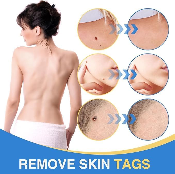 Image of Skin Tag Remover Kit for Face & Body, Upgraded Fast and Easy Removal Pen for Small to Large Size 2mm-8mm, Safe and Painless Clear Skin Tag & Mole, with 40 Removal Bands & 10 Cleansing Wipes