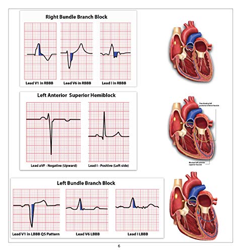 Healthing Aprn World Ekg Pocket Card thumb #5
