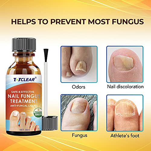 Totclear Nail Fungus Treatment For Toenail Extra Strength Nail Repair Solution Maximum Strength Hydrates Nail Repair Renew Damaged Discolored Foot & Toenails Athletes Foot #TOP1
