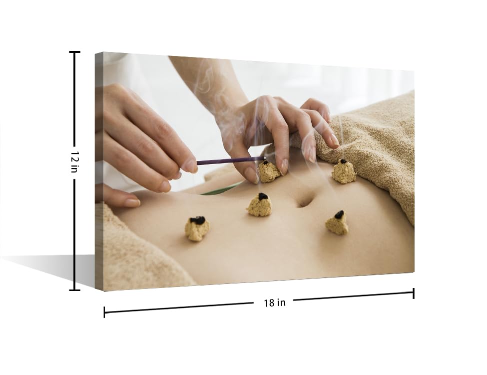 Image of Moxa Moxibustion Prints for Wall Decor Moxibustion Framed Wall Art Posters & Prints 1 Panels Nosocomium Paintings Giclee Print Gallery Packaging Artwork (12 inch Wx18 H)