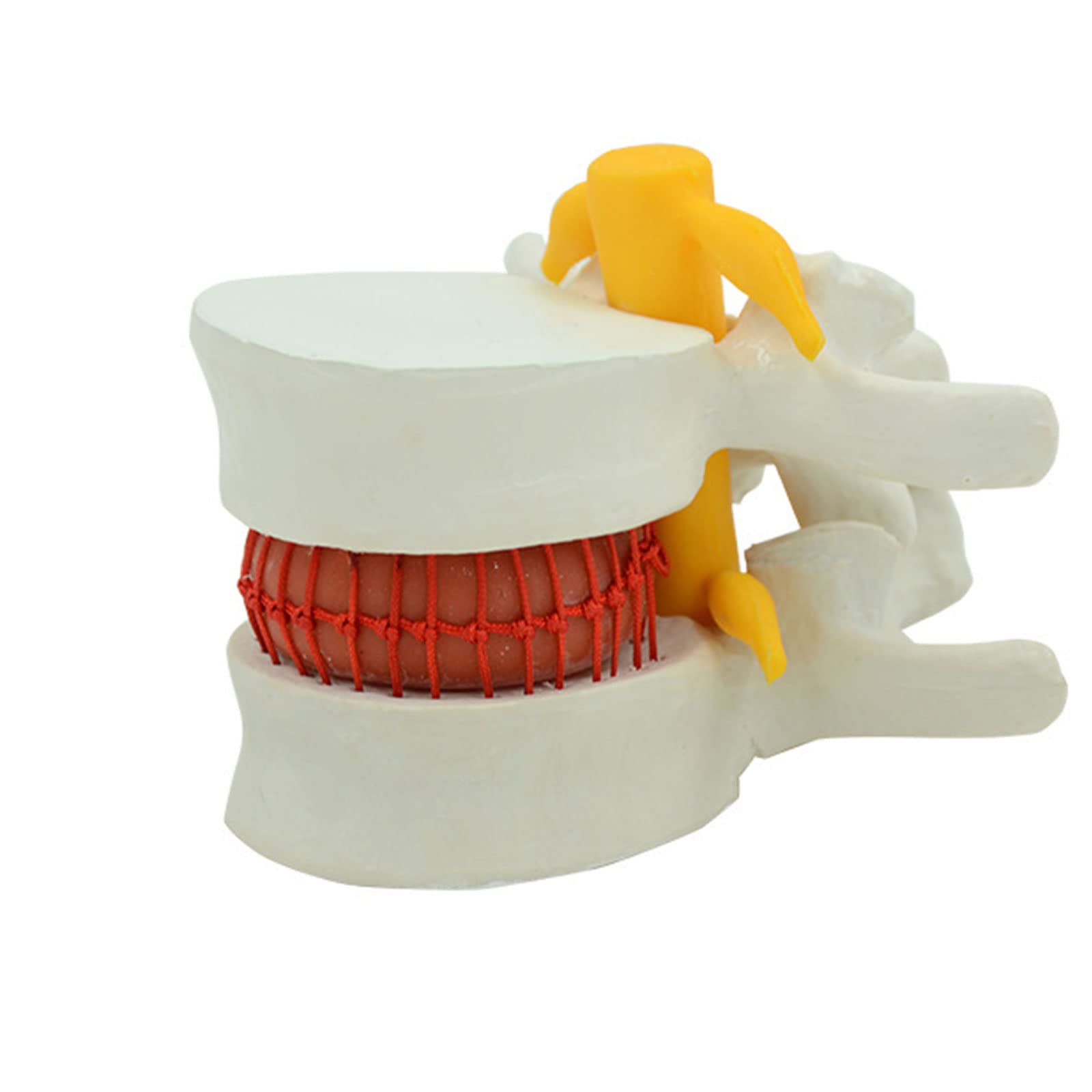 Disc Model Back Buy Anatomical Human Disc Herniation Model, Human Anatomy, Medical ...