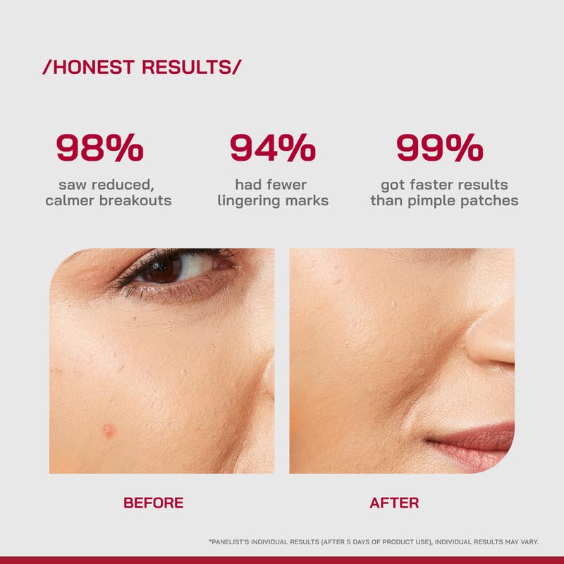 Image of /PHD / Salicylic Acid Acne Spot Treatment Gel 30g | Fast-Acting Pimple Remover & Acne Spot Corrector | Clear Gel with Peptazin Complex | Alternative to Pimple Patches | Salicylic Acid Gel for Face