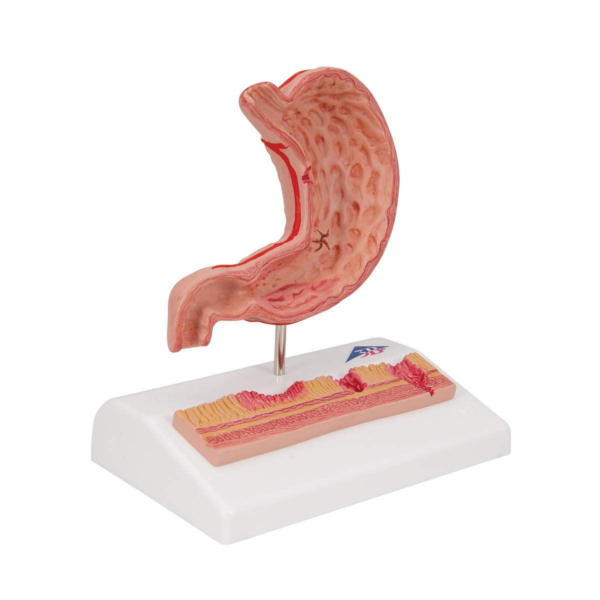 3B Scientific K17 Stomaco con Ulcere Gastriche + software gratuito di anatomia - 3B Smart Anatomy