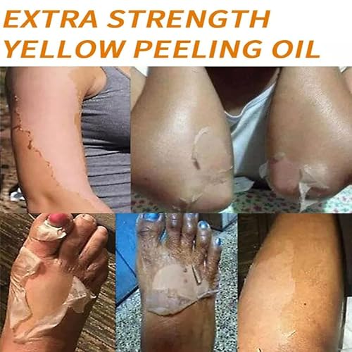 Generic Extra Strong Yellow Peeling Oil for Dark Skin - Exfoliating Solution for Body, Hand, Feet and Face - All Skin Types (110ML/3.88 Fl Oz)