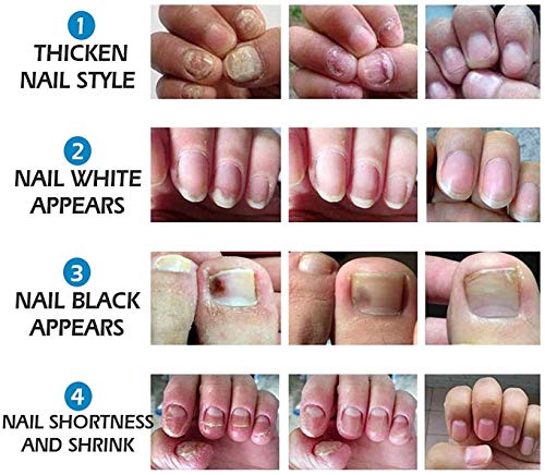 image for TTXS Vibrant Glamour Nail Care Nail Repair Cream Nail Fungus Treatment