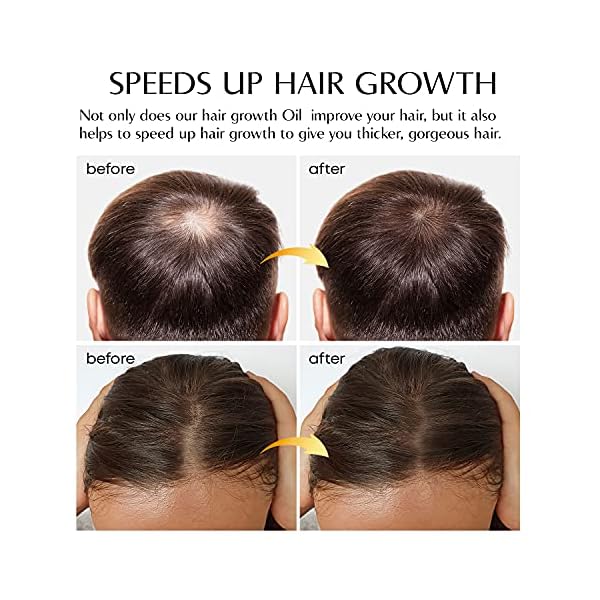 VigorWell Hair Growth Serum Ginger Hair Growth Oil Ginger Prevent Hair Loss and Natural Serum for Thicker, Stronger…