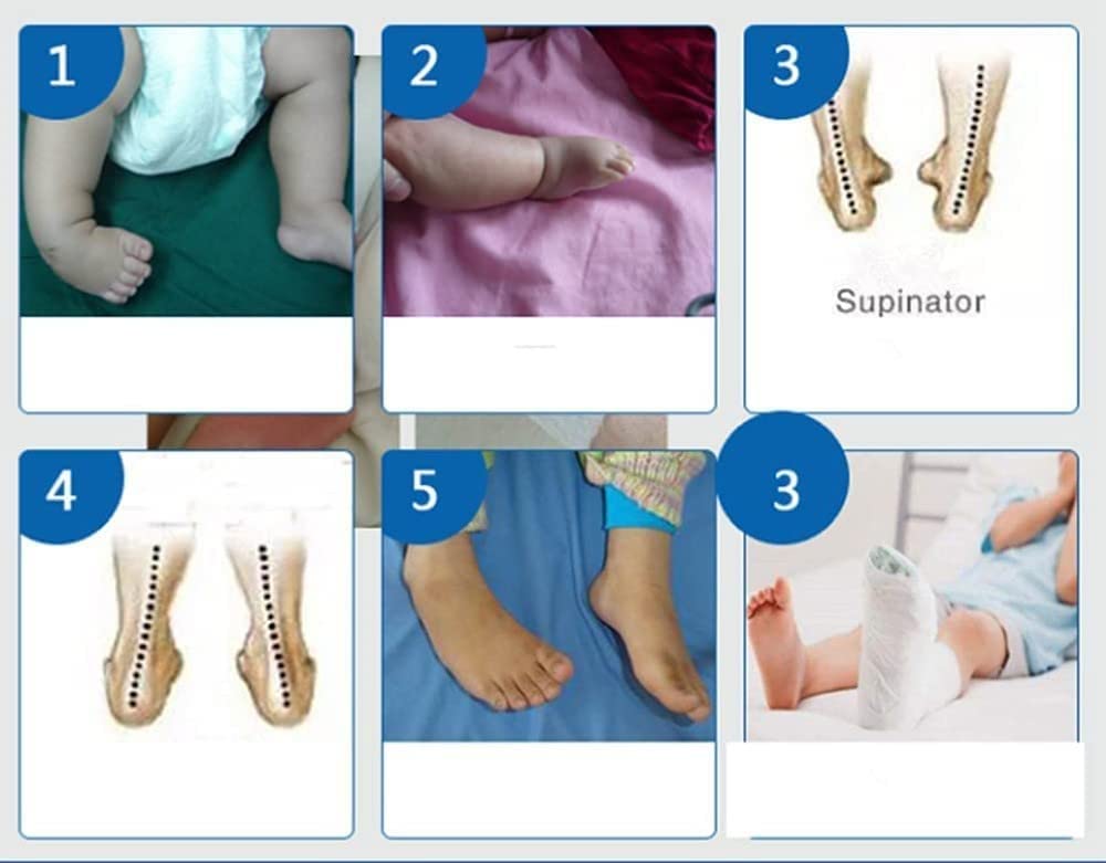 Ortesis de caída de tobillo y pie, férula ajustable for pie, férula de soporte for pie caído, férula de corrección de tobillo, ortesis de caída de pie, rehabilitación de fractura de tobillo, desgarro