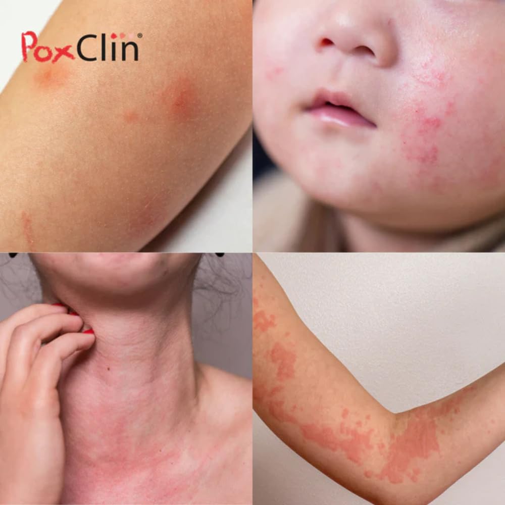 PoxClin® Démangeaisons – Mousse Anti-Démangeaisons – Soulagement en 60 Secondes – Eczéma, Urticaire, Piqûres d’Insectes, Coup de Soleil – Visage & Corps – Dès 12 Mois – 100 ml