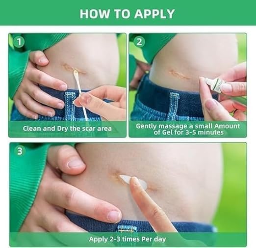 Image of Keloid & Scar Removal Gel - Advanced Silicone Scar Treatment Cream | Fades Acne, Surgery, Injury & Piercing Scars | Smoothens Skin, Reduces Bumps & Marks | 20g Scar Repair Solution (1)