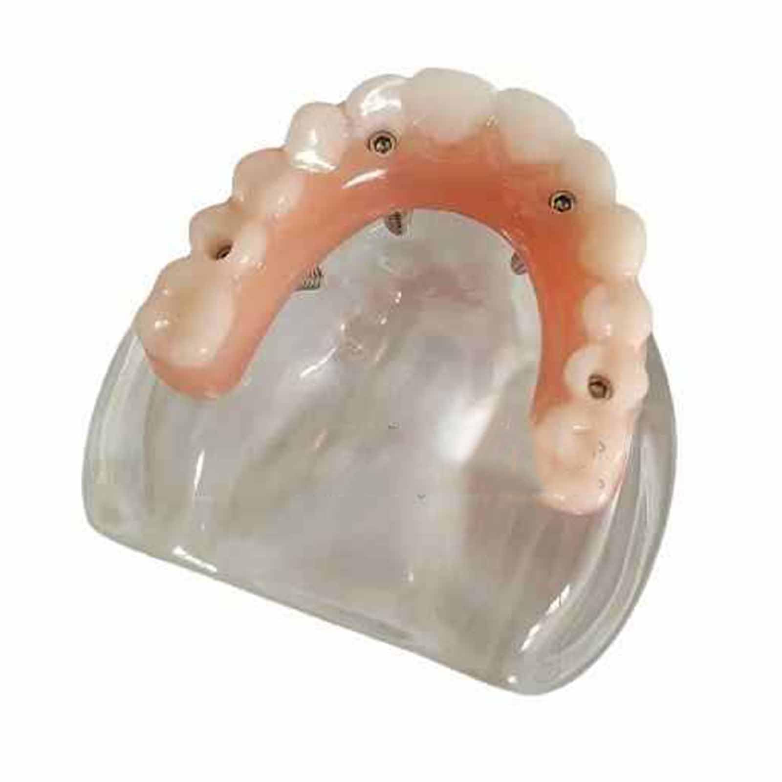 Modèle d'overdenture Modèle de typodont Dentaire Modèle d'implant pour la Recherche, l'enseignement et l'étude en médecine Dentaire