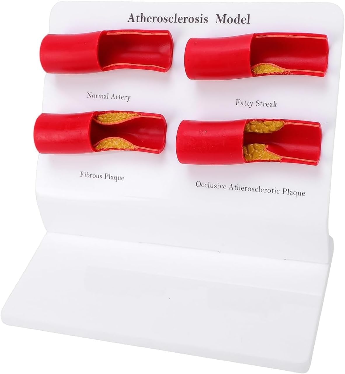 Menschliches Atherosklerosemodell, 4-stufiges pathologisches anatomisches Darstellungsmodell der Arterie, verwendet for medizinische Lehre und Demonstration der Physiologie des