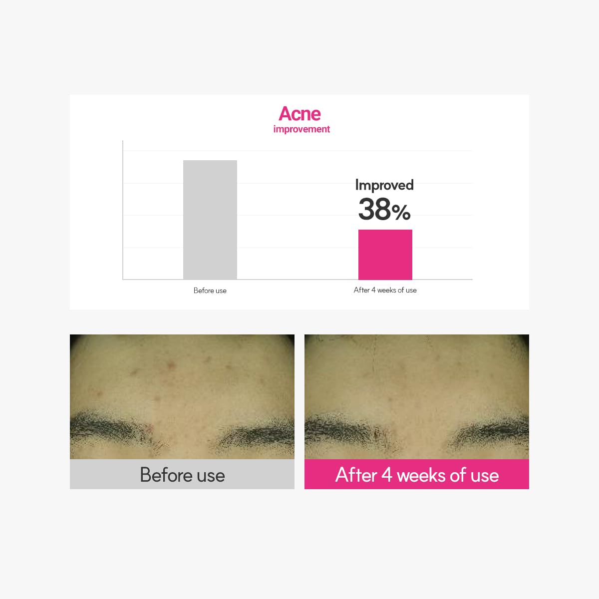 ROVECTIN Cica Care Blemish Clearing Cream: Soothes skin irritation and improves oiliness, sebum, blackheads For Oily Skin | Calamine, Centella Asiatica | Vegan Korean Moisturizer (1.69 fl.oz, 50ml)