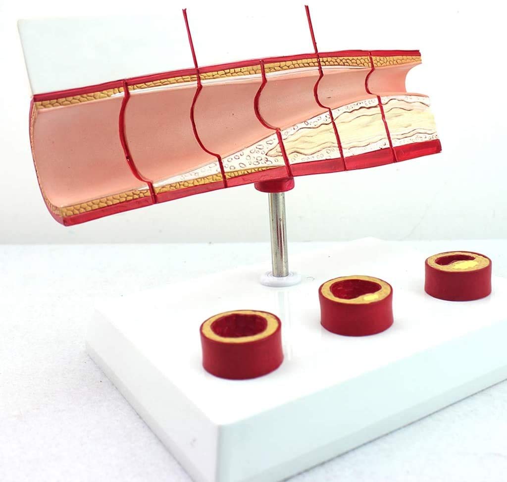 Thrombose Modèle De Processus - Maladie Cardiaque Coronaire Matériel Médical Modèle -PVC Coeur Humain Éducation Médicale Modèle Anatomique pour L'Éducation Médicale
