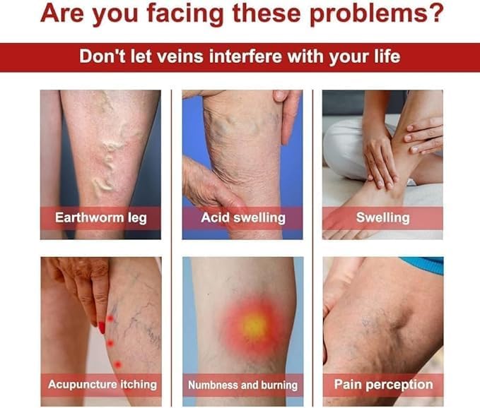 Varicose Veins Patches Dredge Vein Smoothing Veins Reduce Swelling Relieve Pain Instant Relief from Muscular Pain Improve Blood Circulation (1) Varicose Veins Patches Dredge Vein Smoothing Veins Reduce Swelling Relieve Pain Instant Relief from Muscular Pain Improve Blood Circulation (1)