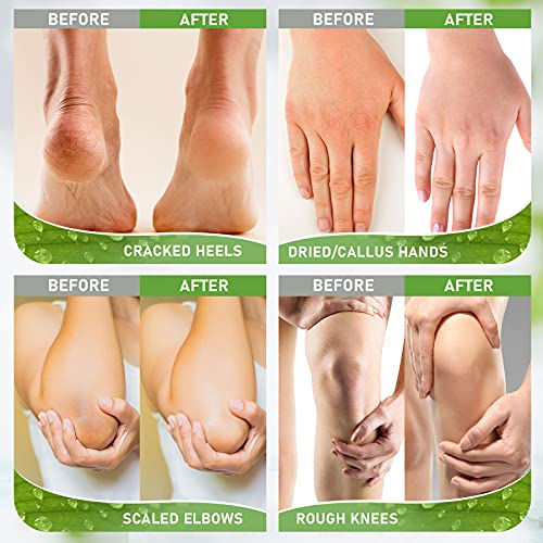 Ultrove Urea Cream 42% - 2% Salicylic Acid Foot Moisturizer - Callus & Dead Skin Remover, Repairing Foot File, 3.5 Oz #TOP6