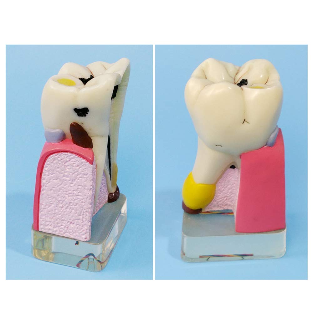 Model Zębów, Model Patologii Stomatologicznej, Analiza Implantów, Demonstracja Crownbridge, Choroba Przyzębia, Różne Zęby, Dziąsła, Narzędzia Do Pielęgnacji Zęb