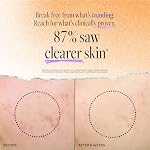 DERMA E Acne Oil Control Face Moisturizer, 2 Oz, Matte Moisturizer with Salicylic Acid, Tea Tree Oil & Aloe Vera, Face Cream Rebalances Sebum Production & Prevents Blemishes, Redness & Breakouts 2 Oz - Image 3