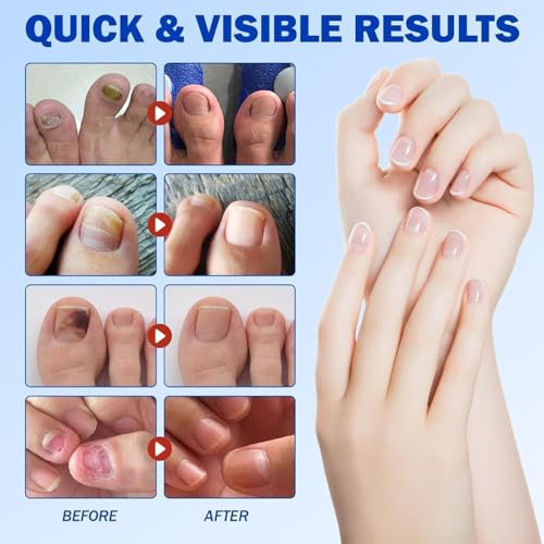 Image of Advanced Fungal Nail Patch Treatment - Powerful Antifungal Solution | Targets Nail Fungus at the Root | Easy-to-Use Patch for Toenail & Fingernail (Pack Of 1)