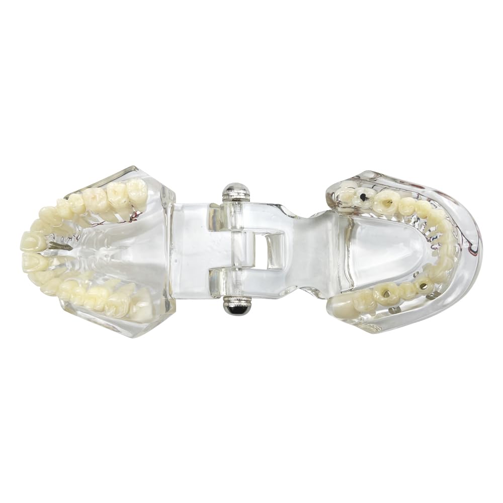 Modello dentale di riparazione neurale Modello dentale Malattia dell'impianto Modello dei denti Dentista Modello di insegnamento patologico standard dei denti rimovibili