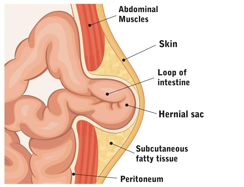 Cinta abdominal para hernia umbilical talla mediana miniatura 4