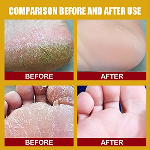 Singove 2Pcs Foot Peeling Foot Mask Cracked Skin Banana Repair Cream Peeling Cream,Antifreeze Cracking Cream, Repair Cream, Moisturize And Repair Dry And Chapped Feet And Hands, Yellow, 6.2*3.6*3.6Cm #TOP5
