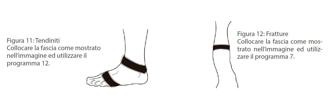 Magnetoterapia con bandas de solenoide CEM MAF para terapia analgésica