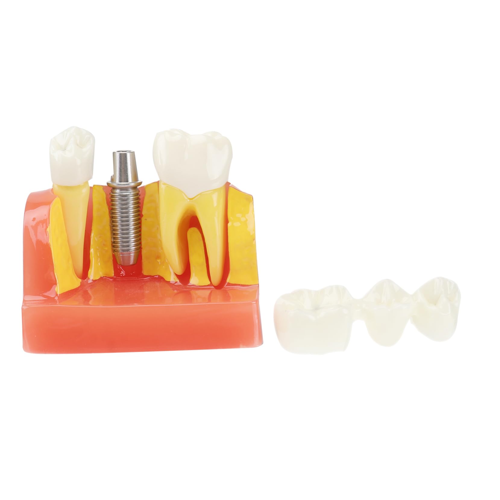 1pezzi Modello di Denti con Denti Rimovibili Strumento Didattico per Insegnamento e Studio Odontoiatrico Modello di Impianto e Protesi Fissa Incluso