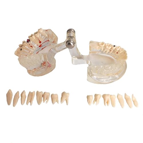 Miniatura 8 de Reparación neural Modelo dental Enfermedad del implante Modelo de dientes Dentista Estándar Patológico Dientes removibles Modelo de enseñanza para