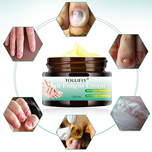 Nail Fungus Cream,Toenail Fungus Treatment,Nail Fungus Remover,Toenail Fingernail Fungus Remover Fungus Stop Cream