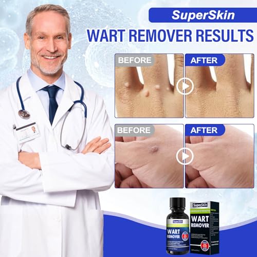 Fast Action Liquid Wart Gel Maximum Strength Liquid with Salicylic Acid - Fast-Acting Wart Liquid Freeze Off Designed for Warts, Plantar Wart, Genital Wart, Common Wart, Flat Wart, Corn, Callus
