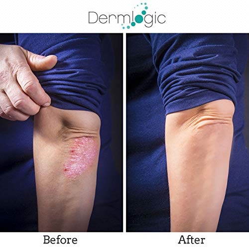 Keratosis Pilaris Treatment- Get Rid Of Kp, Bumps & Body Acne. 12% Lactic Acid Lotion. Moisturizing Repair Cream Smooths Rough, Dry, Cracked, Bumpy Skin & Redness. #TOP3