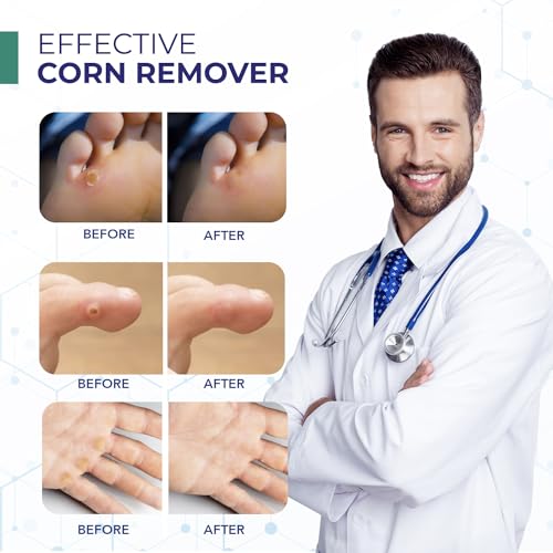 Image of Corn Removers for Toes: Liquid Salicylic Acid Corn Removal for Feet - Corn Callus Remover for Feet Extra Strength (0.5 Fl Oz)