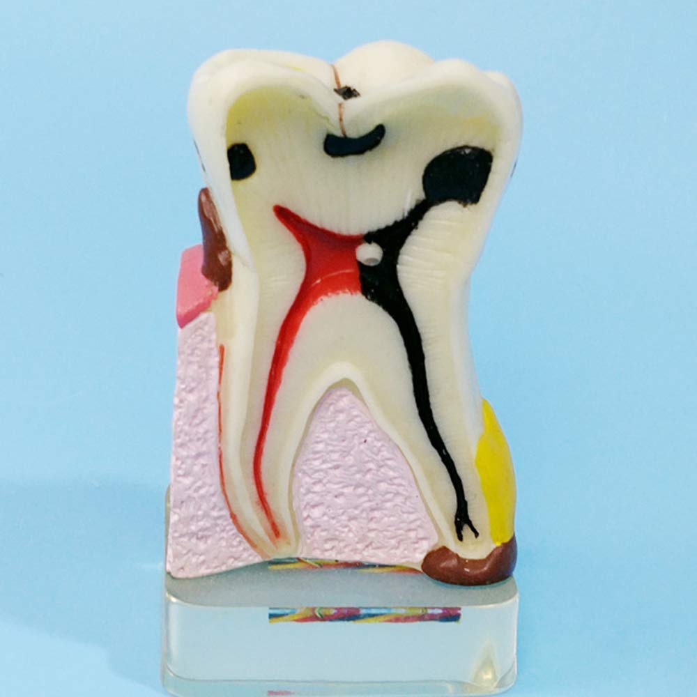 Model Zębów, Model Patologii Stomatologicznej, Analiza Implantów, Demonstracja Crownbridge, Choroba Przyzębia, Różne Zęby, Dziąsła, Narzędzia Do Pielęgnacji Zęb