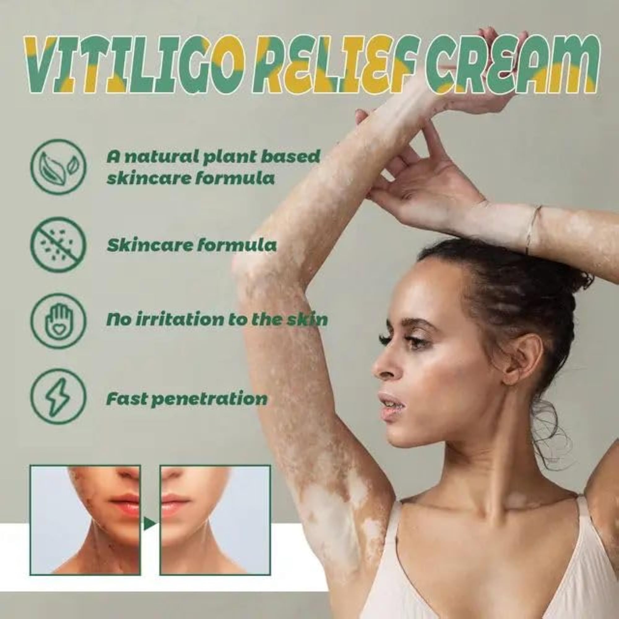 ZeroPathy Herbal Spot Care for Vitiligo, Ayurvedic Skin Tone Cream
