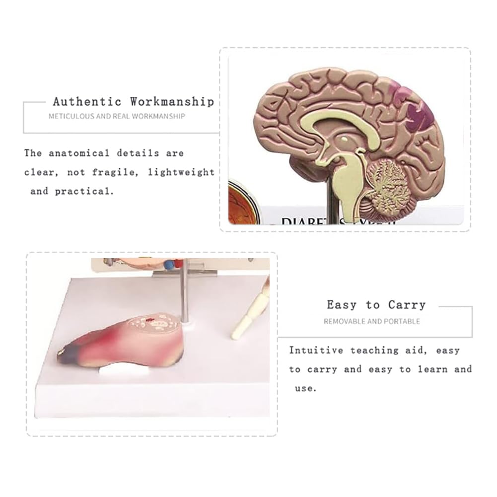 Modèle médical de diabète Modèle Anatomique de diabète Organe Humain Amovible Complications anatomiques du diabète Modèle d'affichage pour la médecine