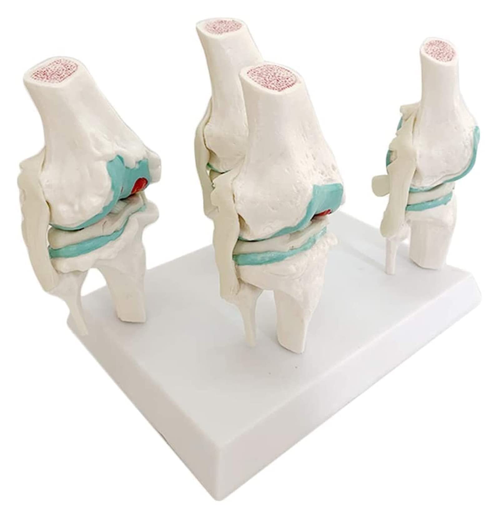 Anatomy Model, Knee Joint Model Four Stages of Pathological Joints Human Medical Anatomy Flexible Knee Skeleton Teaching Mold,Skeleton
