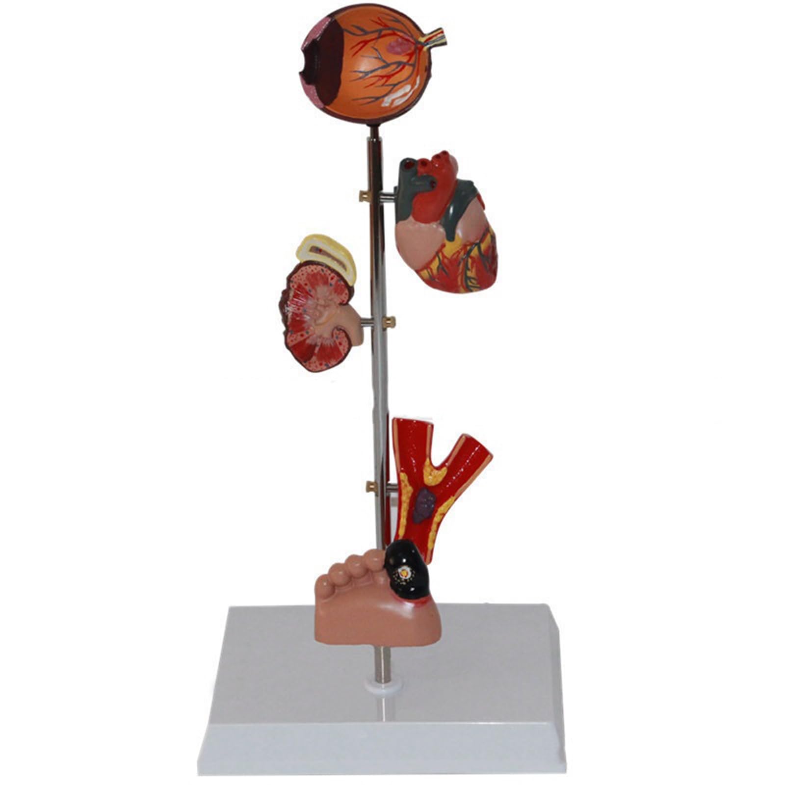 Human Organ Dissection Model Diabetes Pathology Demonstration Anatomy Model Pathological Model Human Diabetic Organ Model Diabetes Complications Display Model Pathological Diabetes Anatomy Model