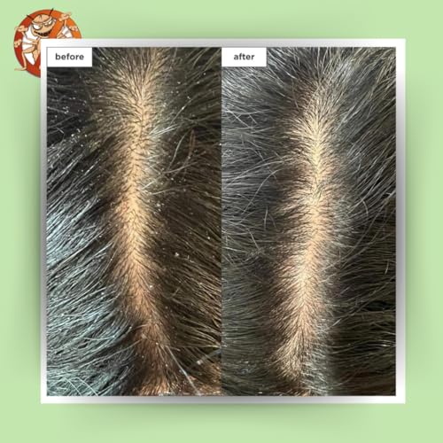 Image of Tea Tree Natural Anti Lice and Nits Shampoo 300 ml with Transparent Lice Removal Comb With Tea Tree and Neem Extracts(Pack of 3)