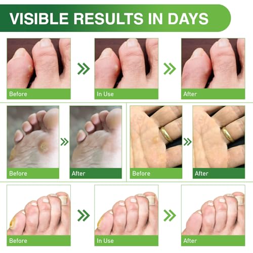 Image of Ulensy Corn Remover Pads for Feet and Toes: 30-Pack Sast Effective Medicated Bandages for Kids Adults Seniors Teens Workers Men Women - alicylic Acid Extra Strength Treatment